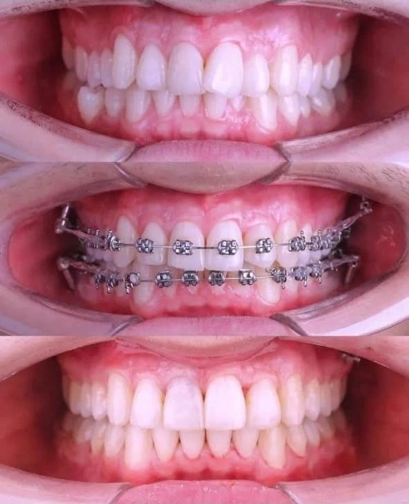 Caso clínico: Alineación Dental con Brackets