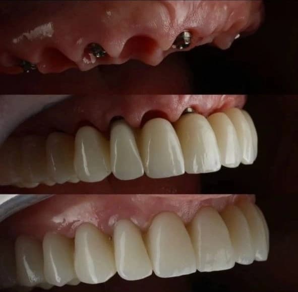 Caso clínico: Implante Dental Unitario