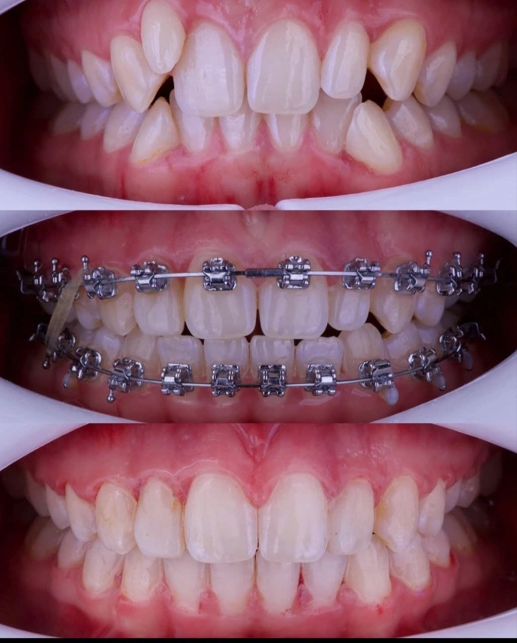Caso clínico: Alineación Dental con Brackets