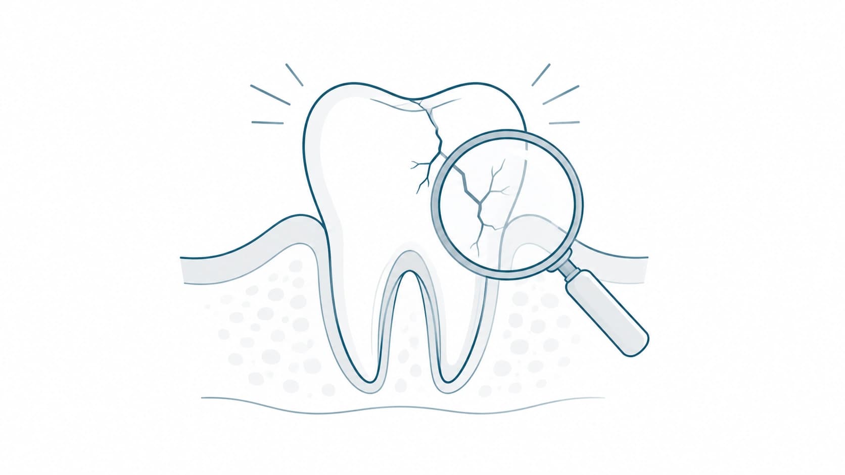 Fractura dental con posible daño pulpar