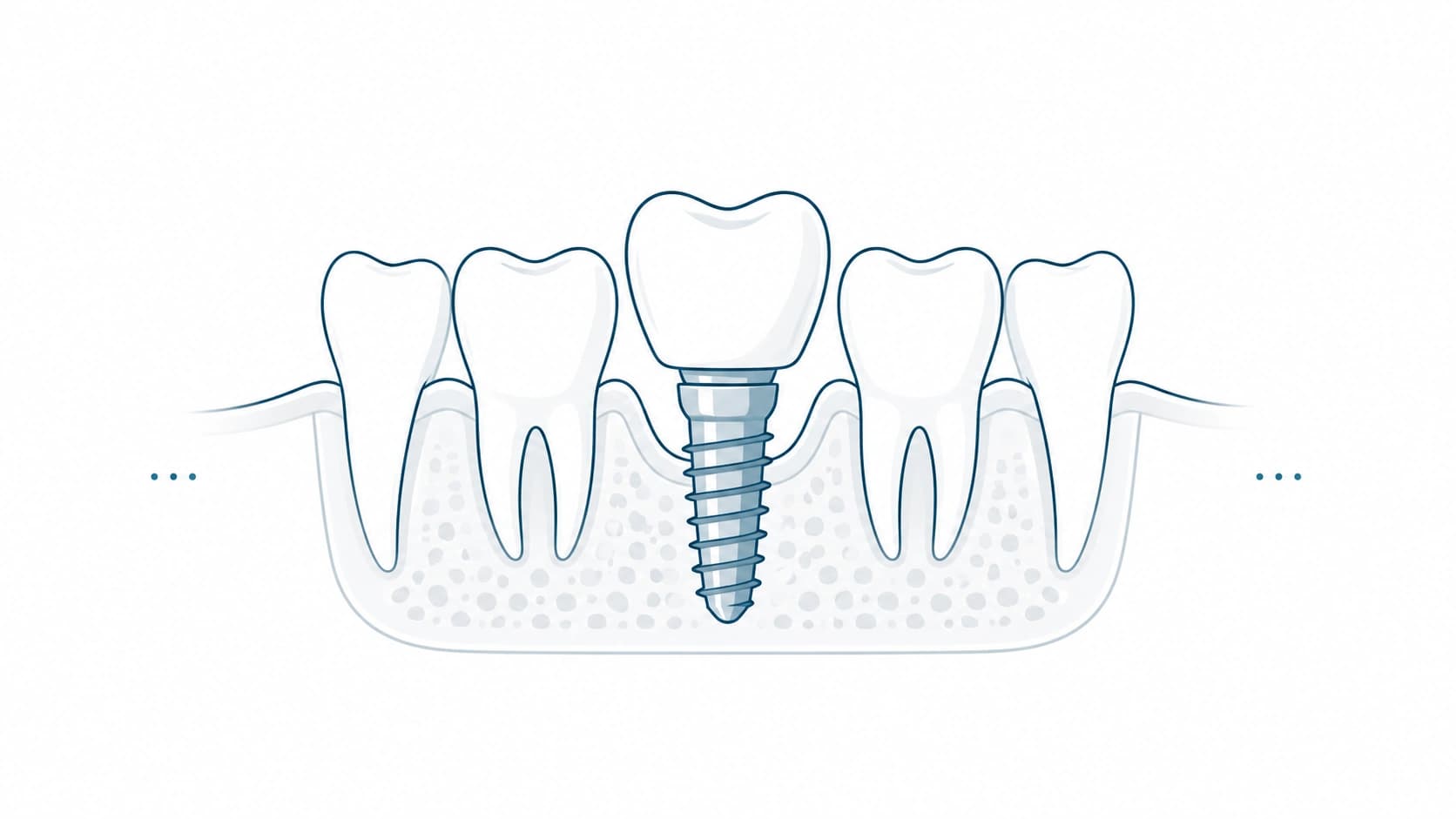 Rehabilitación oral con implantes dentales