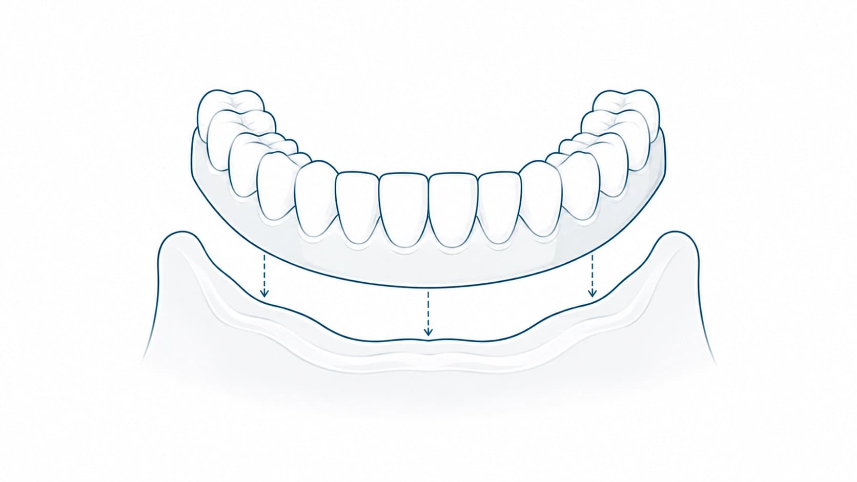 Prótesis dental parcial o total