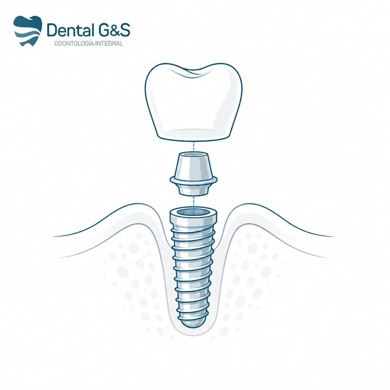 Diagrama de implante dental con corona y pilar