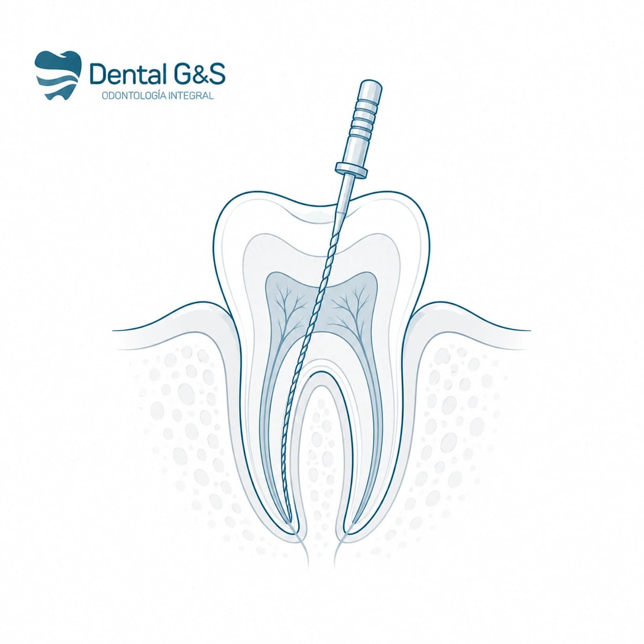 Instrumental clínico para tratamiento de endodoncia