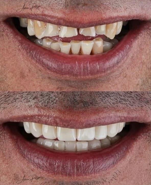 Caso clínico: Restauración de dientes fracturados