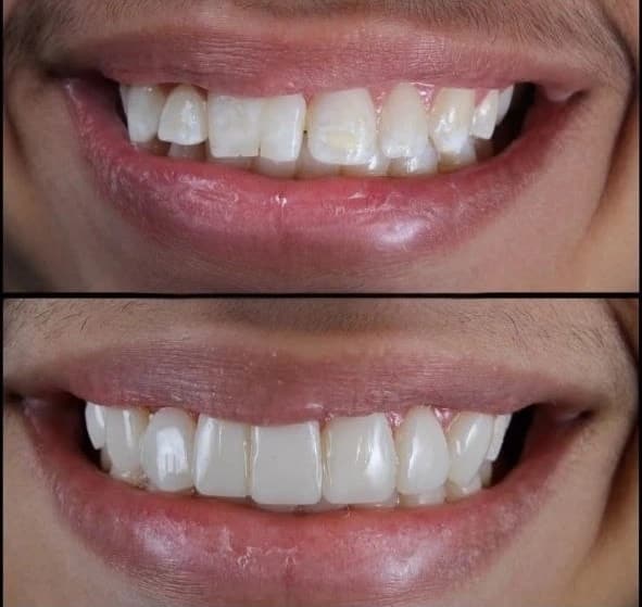 Caso clínico: Cierre de diastema con carillas