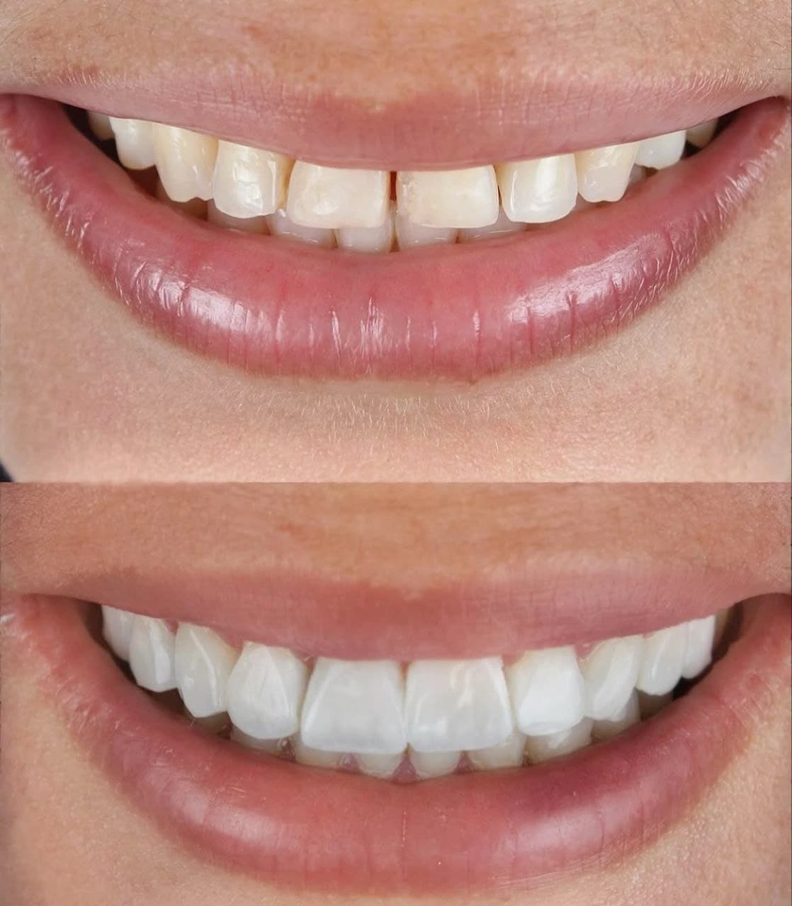 Caso clínico: Armonización de sonrisa con carillas
