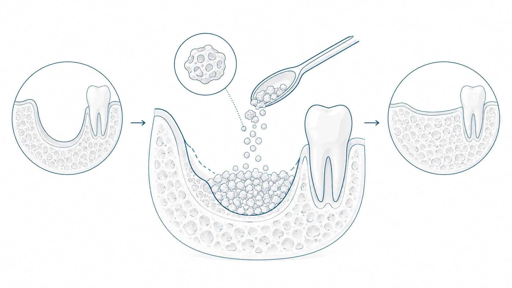Injerto o regeneración ósea dental