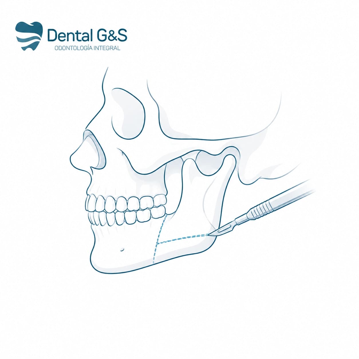 Instrumental clínico para cirugía maxilofacial